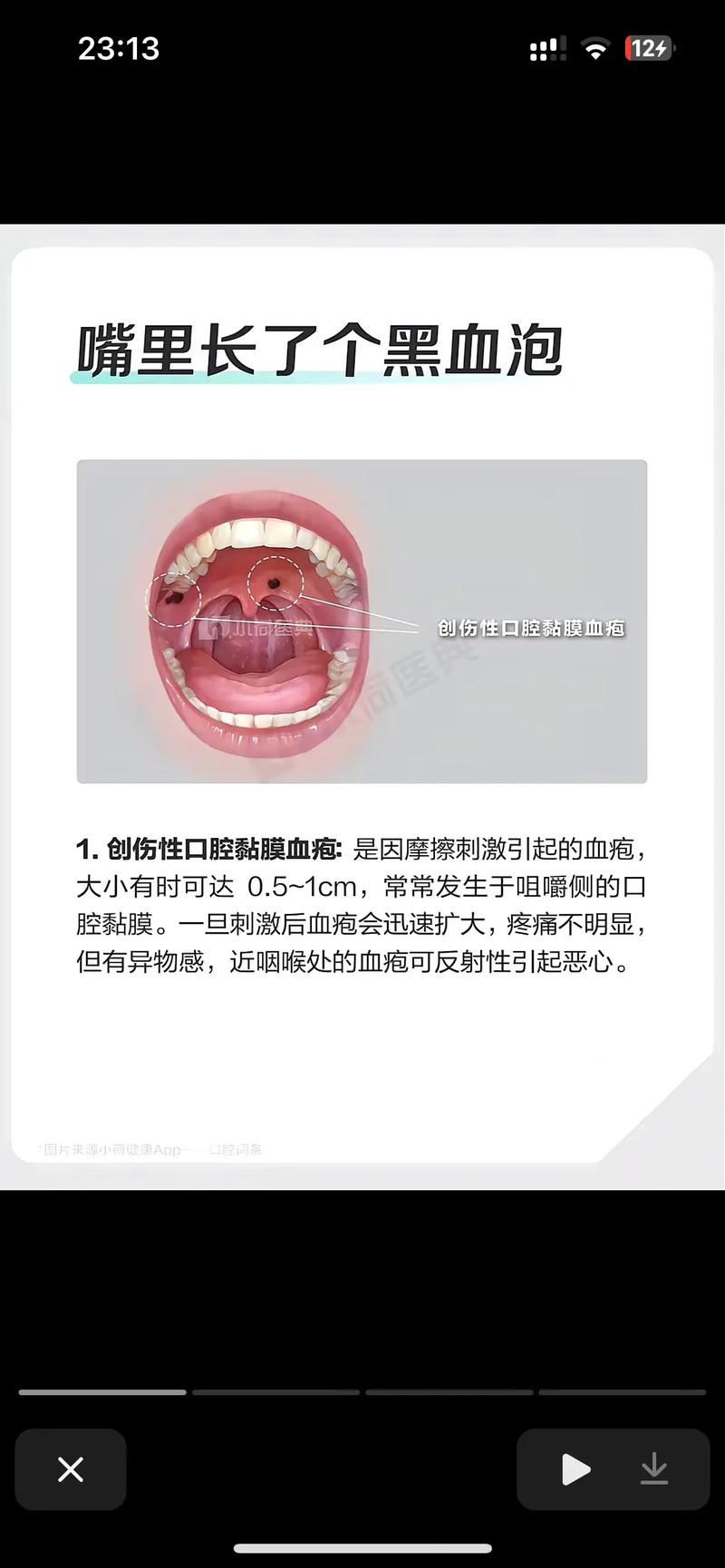 口腔内壁里长泡怎么办