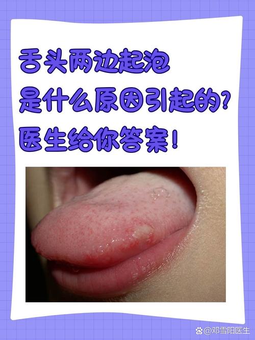 吃槟榔口腔起泡怎么办