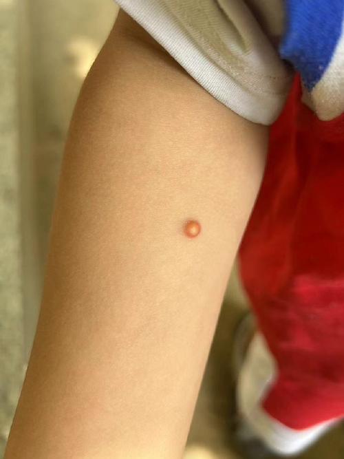 皮肤上长了一个小肉芽