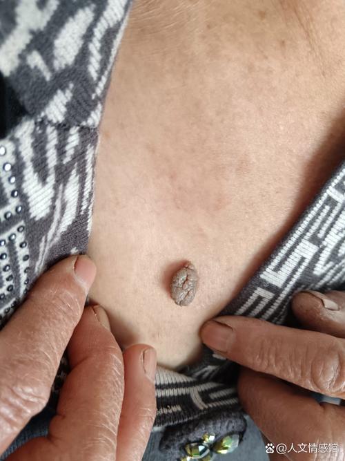 皮肤上长了一个小肉芽