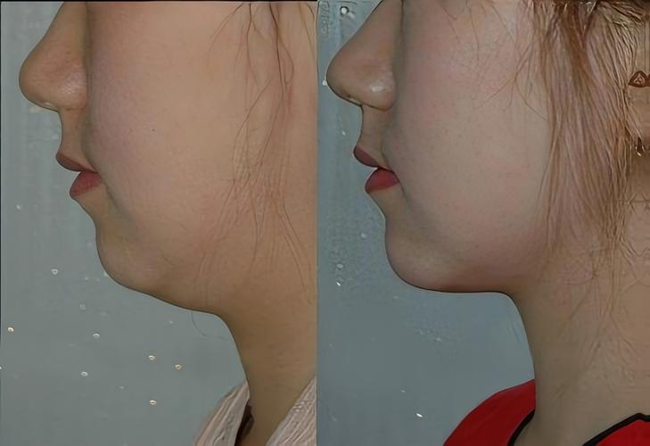 打溶脂针皮肤会松弛吗