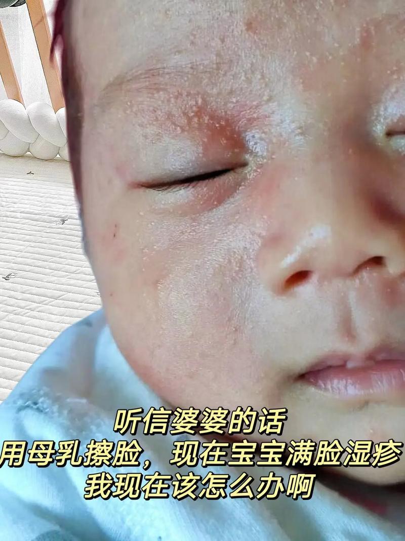 月子里皮肤过敏,怎么办?