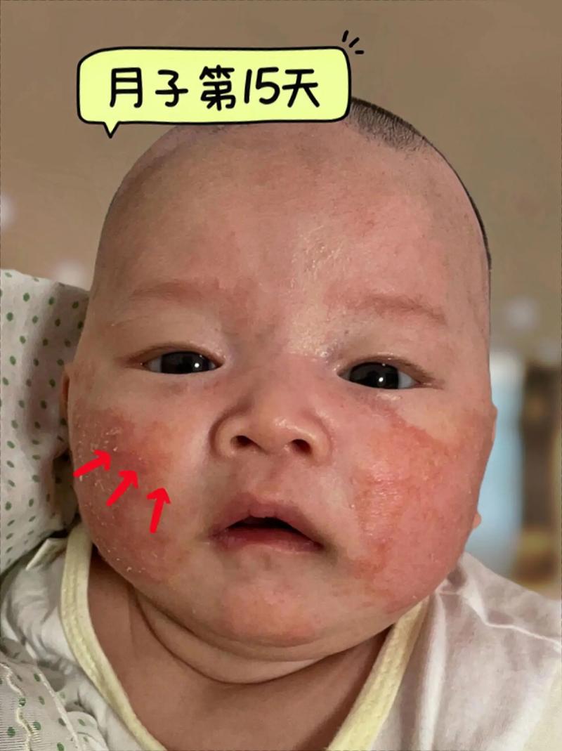 月子里皮肤过敏,怎么办?