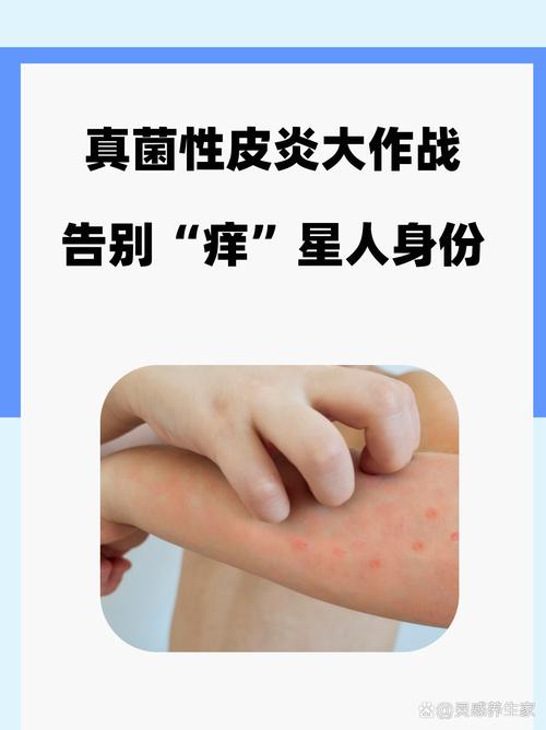 皮肤真菌感染了怎么办?