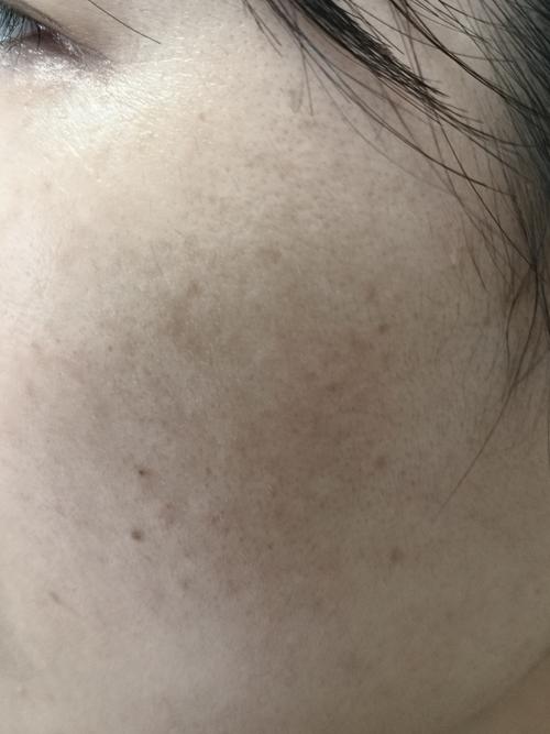黑色素沉淀图片如何淡化改善?