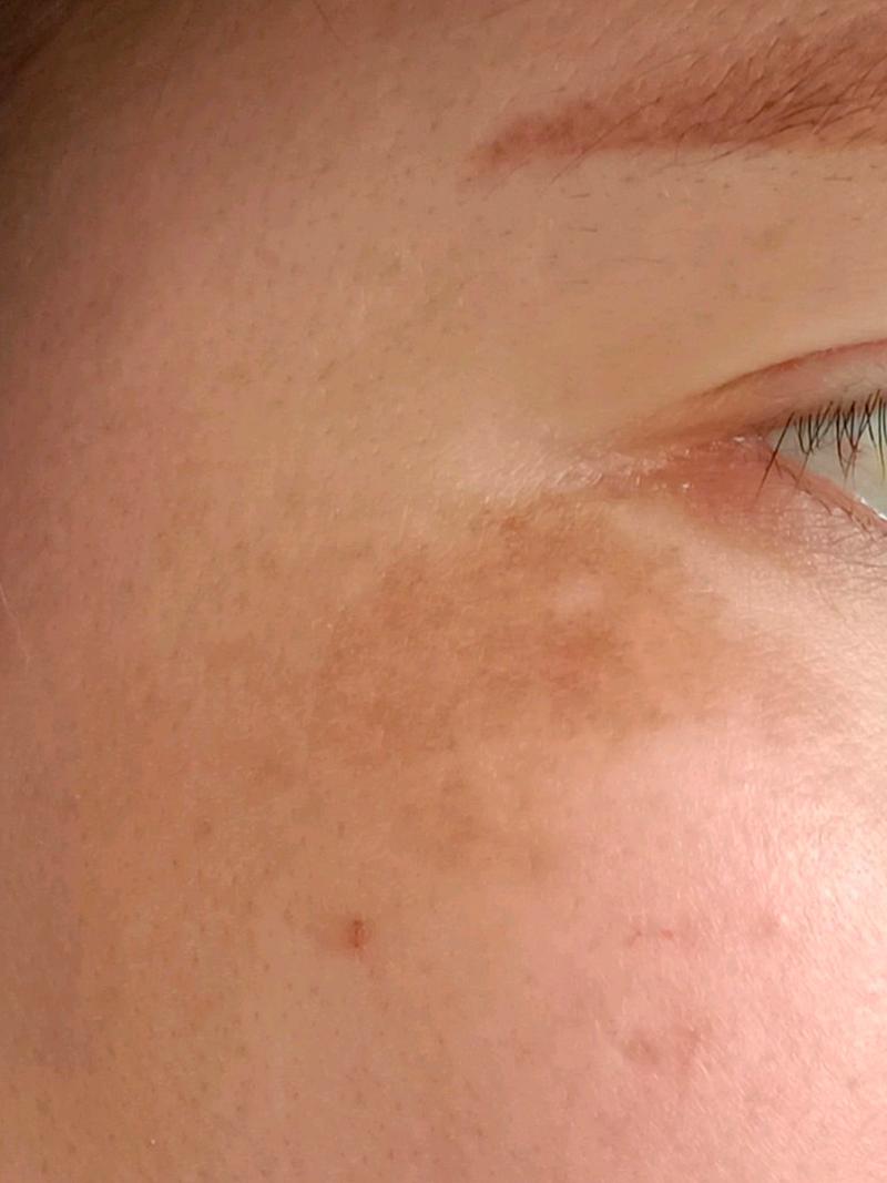 黑色素沉淀图片如何淡化改善?