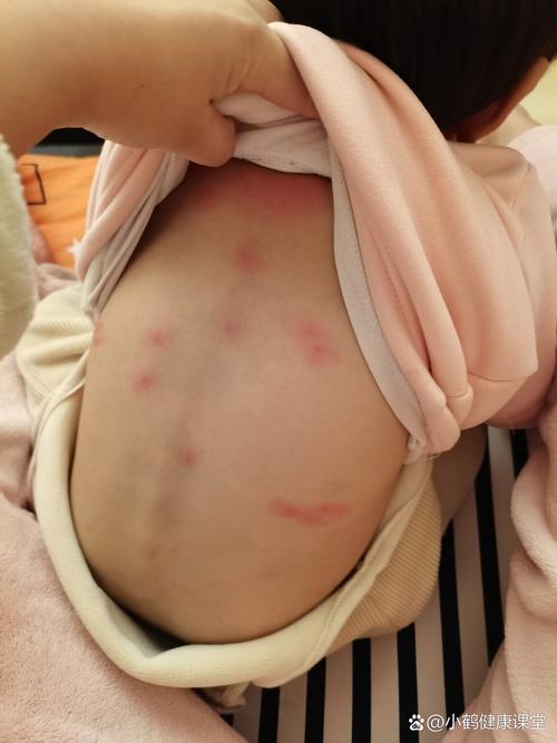 小孩皮肤起红疙瘩很痒怎么办?