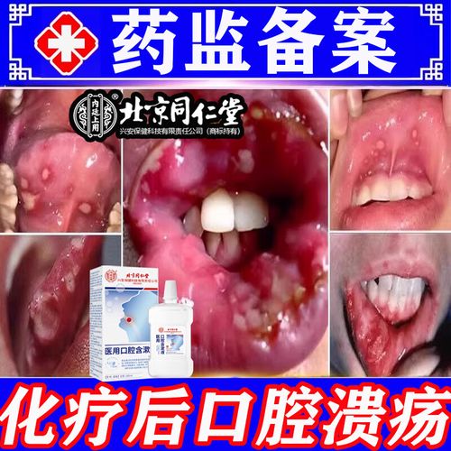 放疗后口腔溃烂怎么办?