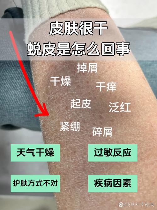 皮肤干燥脱屑是缺水还是生病了?