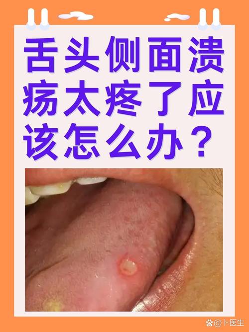 口腔溃疡接吻会传染吗?