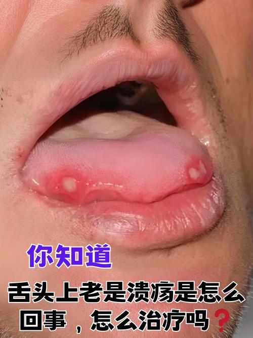 口腔溃疡接吻会传染吗?