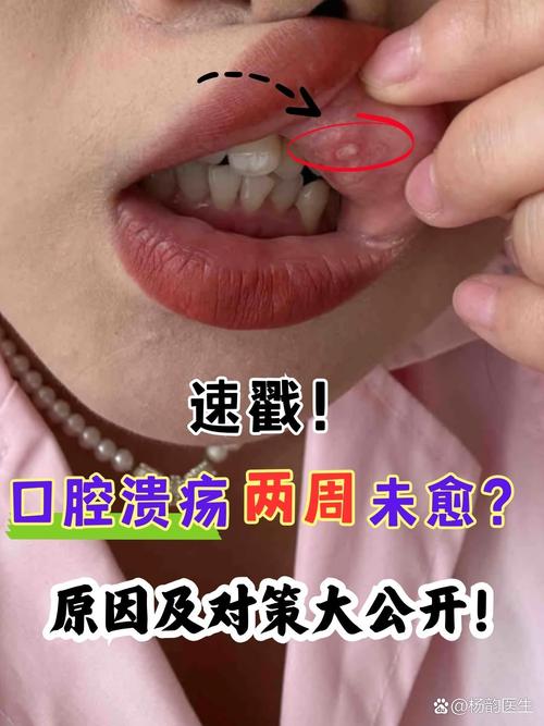 口腔溃疡接吻会传染吗?