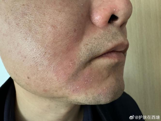 脸上皮肤为何突然变磨砂皮?