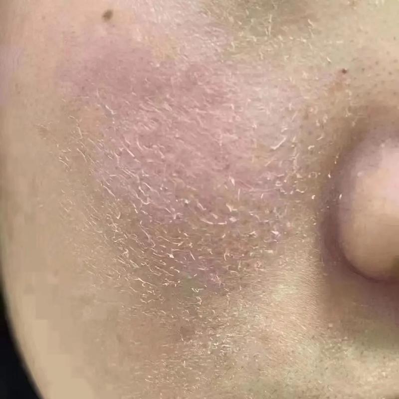 脸上皮肤为何突然变磨砂皮?