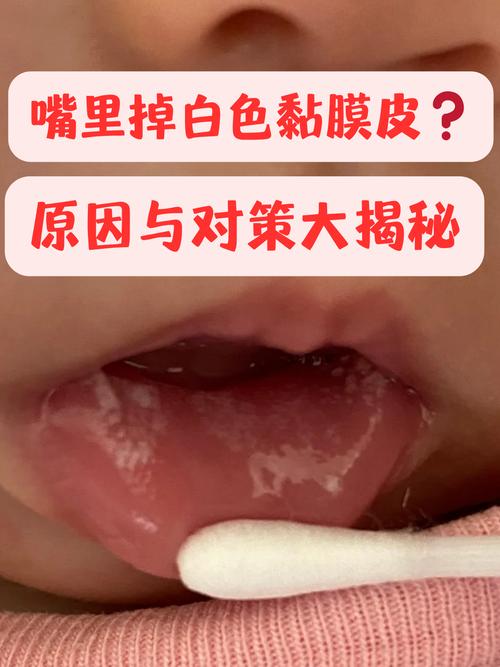 口腔皮脂腺异位会自行消失吗?