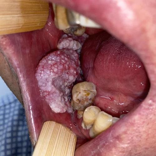 口腔皮脂腺异位会自行消失吗?