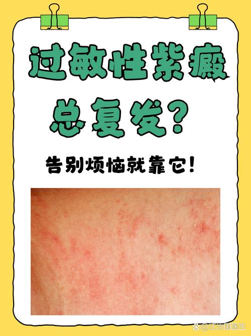 皮肤过敏紫癜怎么治疗