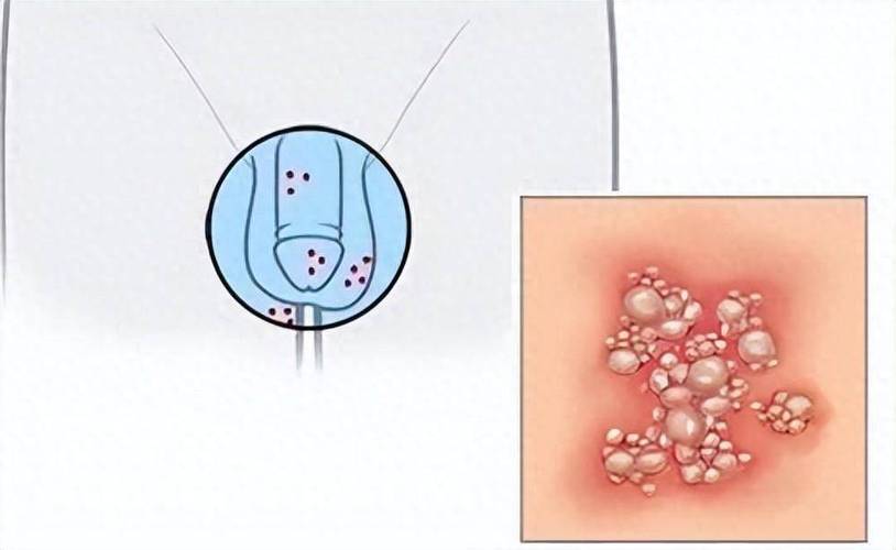 生殖器疱疹口腔传染途径有哪些?