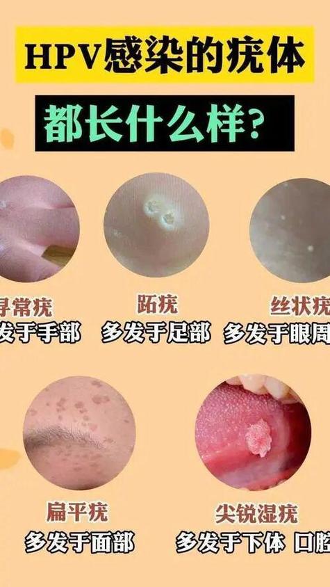 口腔尖锐湿庞能彻底治愈吗?