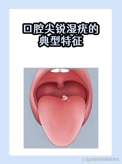 口腔尖锐湿庞能彻底治愈吗?