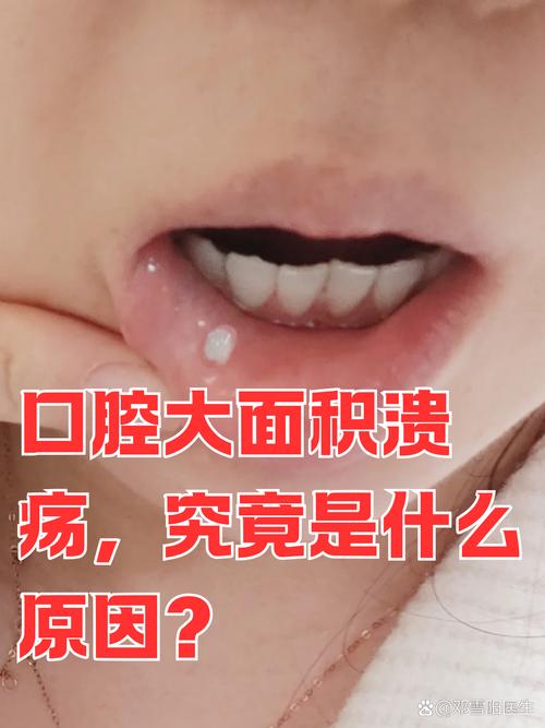 口腔溃疡会引起低烧吗