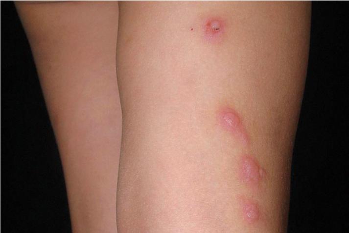 皮肤里有虫子是什么病