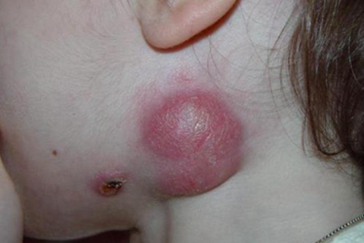 皮肤里有虫子是什么病