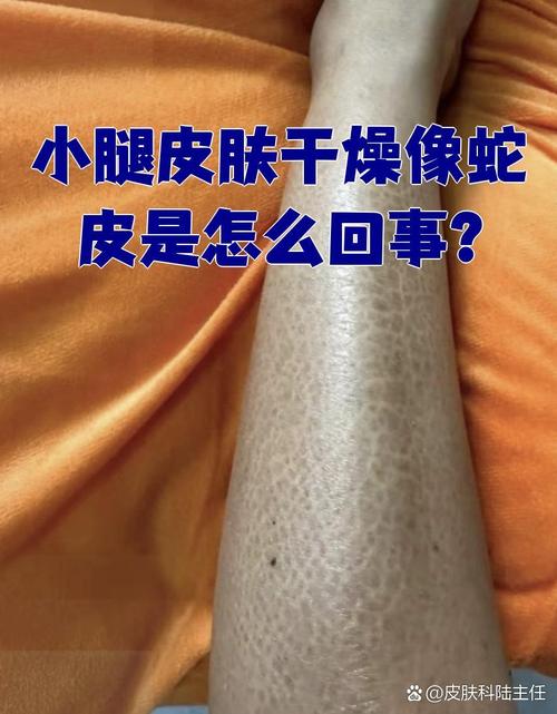 小腿皮肤干燥如鱼鳞,怎么办?