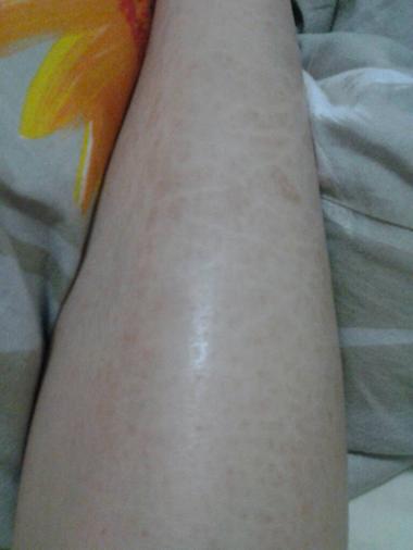 小腿皮肤干燥如鱼鳞,怎么办?