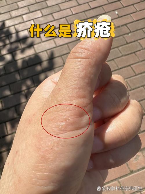 皮肤病疥疮怎么引起的