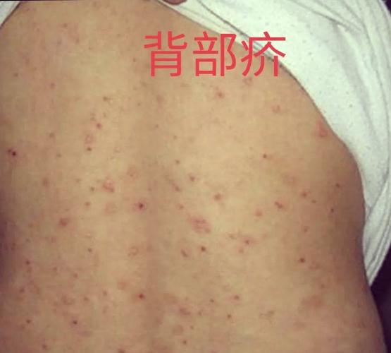 皮肤病疥疮怎么引起的