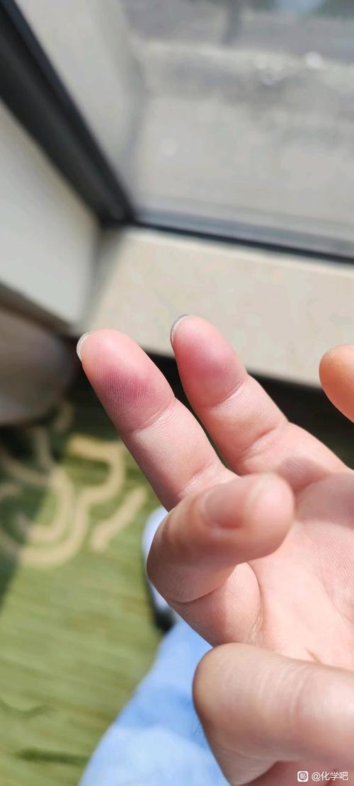 氢氟酸沾皮肤如何紧急处理?