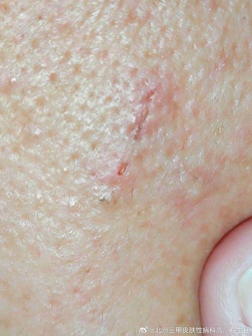 皮肤毛孔出血是何病征兆?