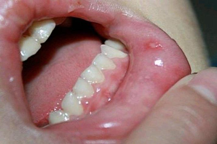 一岁宝宝口腔疱疹图片长啥样?