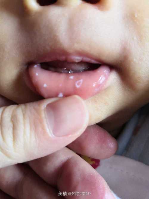 一岁宝宝口腔疱疹图片长啥样?