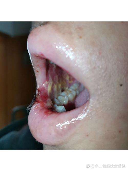 化疗后口腔大面积溃疡怎么办?