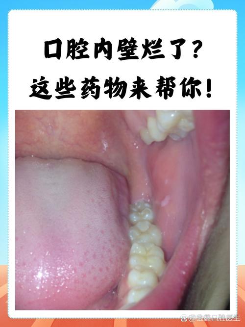 口腔内壁增厚是何原因?