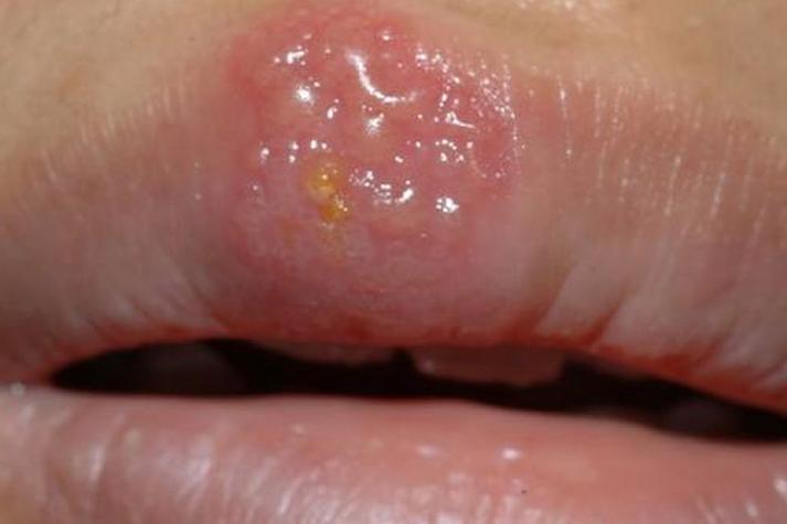 疱疹性口腔溃疡症状有哪些?