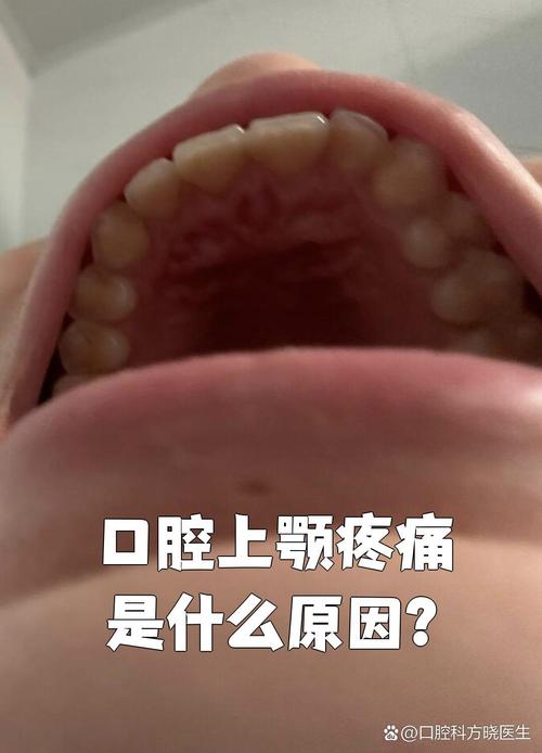 口腔上颚麻是什么原因