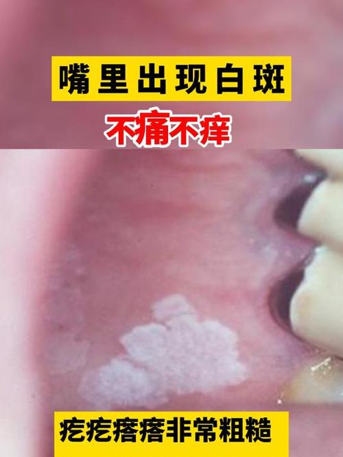 口腔内白点颗粒状是何问题?