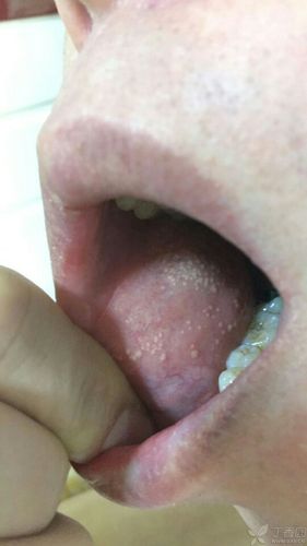 口腔内白点颗粒状是何问题?