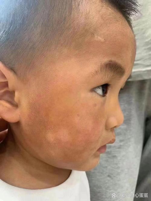 小孩皮肤白斑是啥原因?