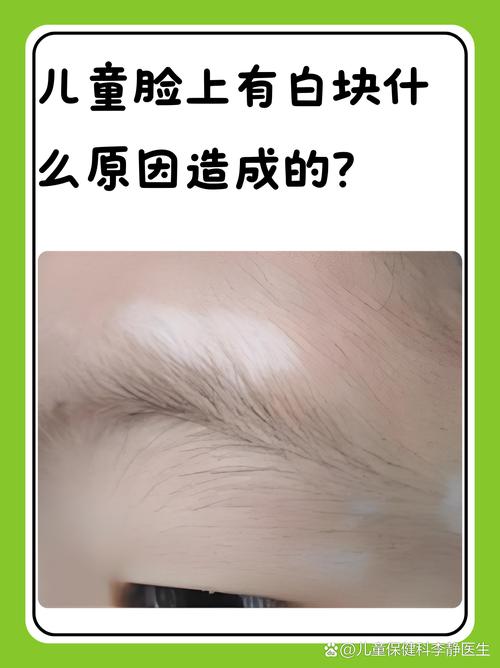 小孩皮肤白斑是啥原因?