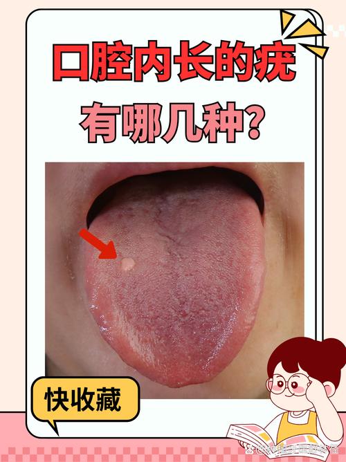 口腔血管瘤怎么引起的