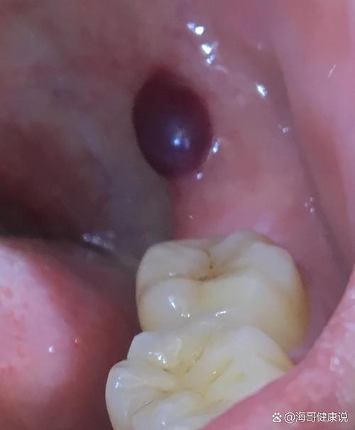 口腔血管瘤怎么引起的