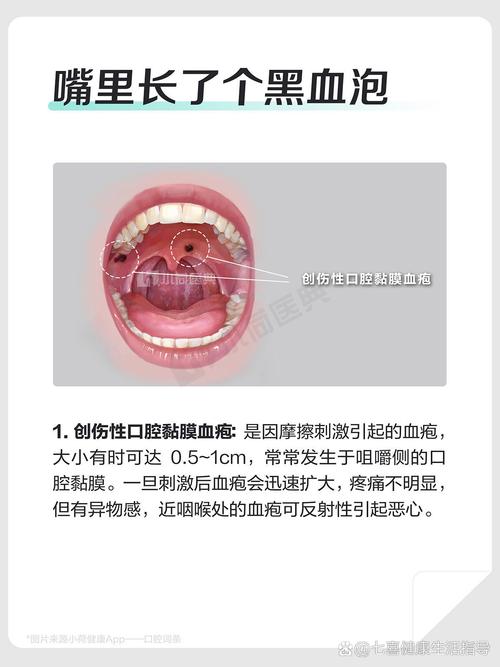 口腔血管瘤怎么引起的