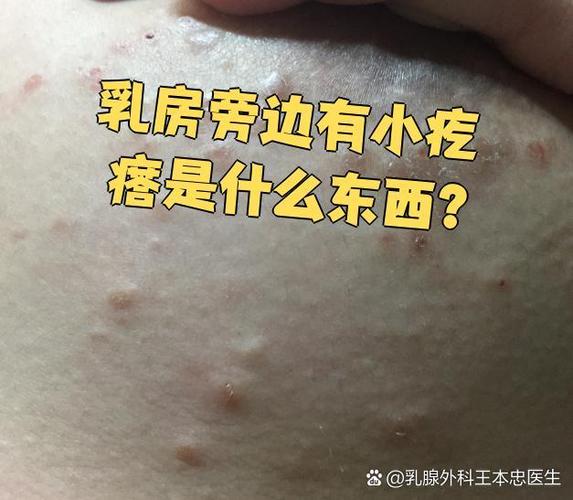乳房皮肤长疙瘩是何问题?