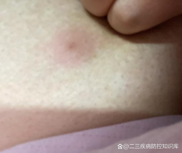 乳房皮肤长疙瘩是何问题?
