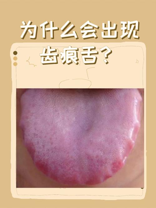 舌有齿痕、口腔溃疡,是脾虚还是上火?