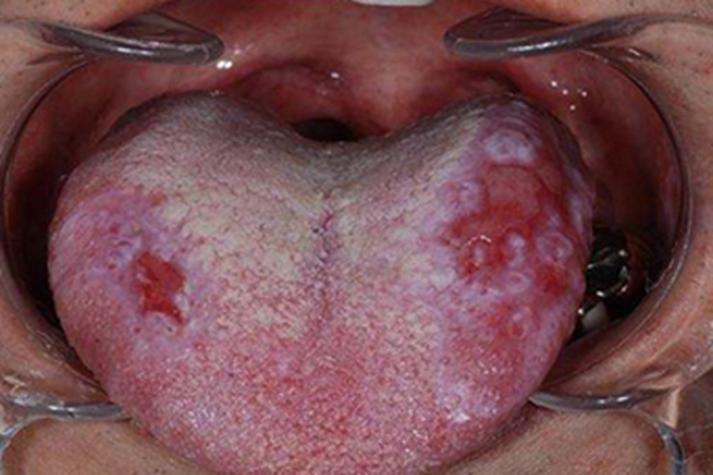 舌有齿痕、口腔溃疡,是脾虚还是上火?